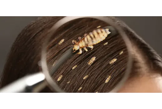 Head Lice Treatment